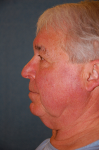 Facial Surgery - Men Patient 91240 Before Photo # 7