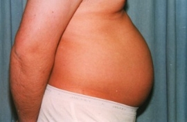 Liposuction Patient 27041 Before Photo # 5