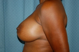 Breast Augmentation Patient 26729 After Photo # 6