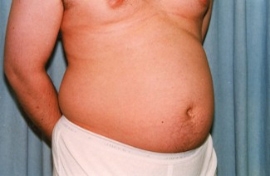 Liposuction - Men Patient 57026 Before Photo # 3