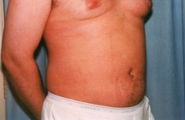 Liposuction - Men Patient 57026 After Photo # 4