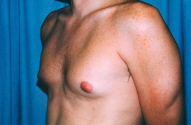 Gynecomastia Patient 22087 Before Photo # 1