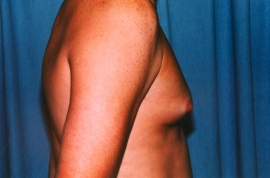 Gynecomastia Patient 22087 Before Photo # 3