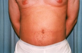 Liposuction - Men Patient 57026 After Photo # 2