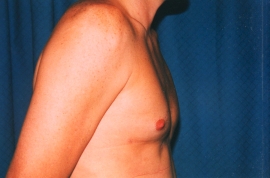 Gynecomastia Patient 22087 After Photo # 4