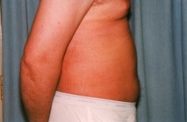 Liposuction - Men Patient 57026 After Photo # 6