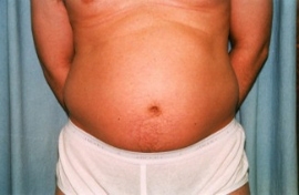 Liposuction - Men Patient 57026 Before Photo # 1