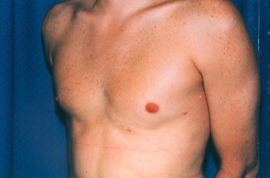 Gynecomastia Patient 22087 After Photo # 2