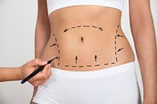 A doctor drawing liposuction guidelines on a womans abdomen