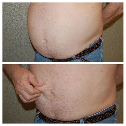 Intra-abdominal fat | Abdominoplasty and Internal Fat | Central Fat | Visceral Fat