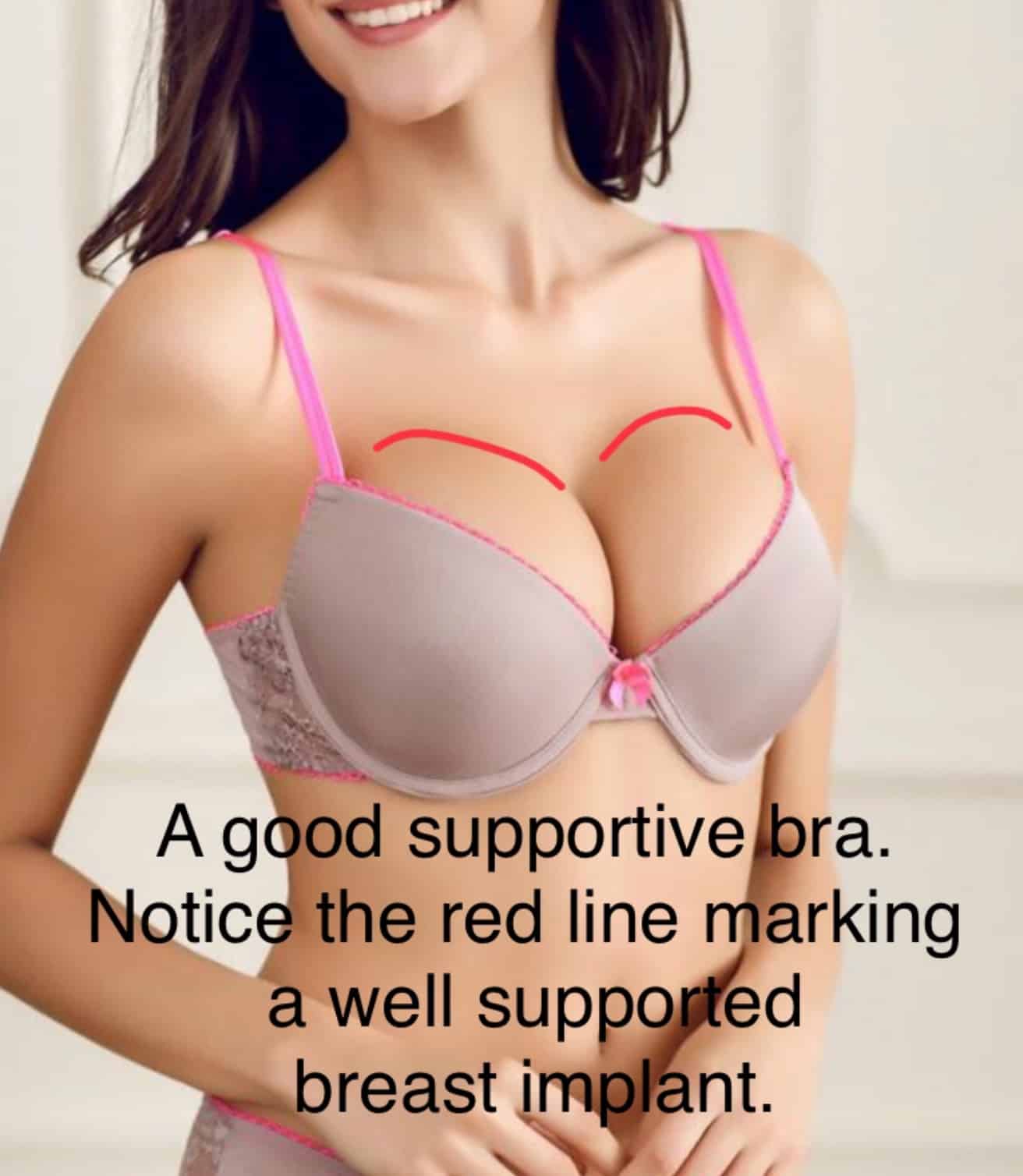 Chris Saunders MD  When Do I Wear a Bra after Breast Augmentation