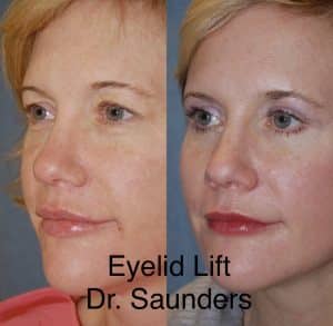 Eyelid lift: Before and after