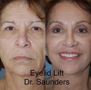 Eyelid lift: Before and after