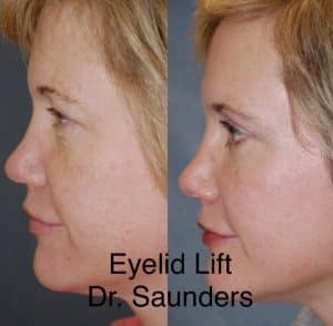 Eyelid lift: Before and after