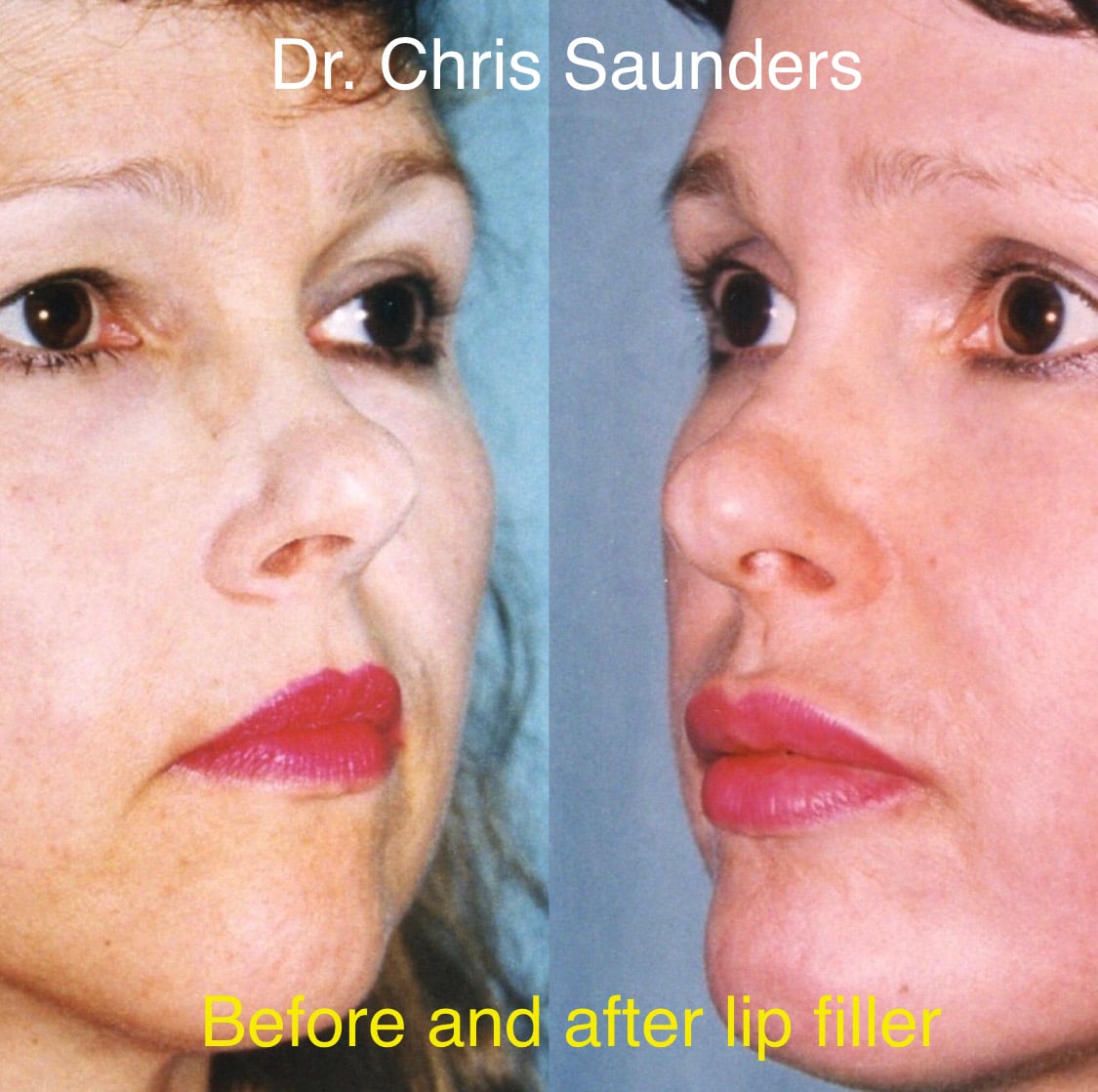 Before and After Lip filler