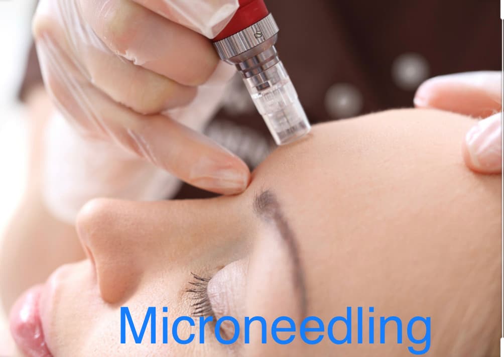 Microneedling