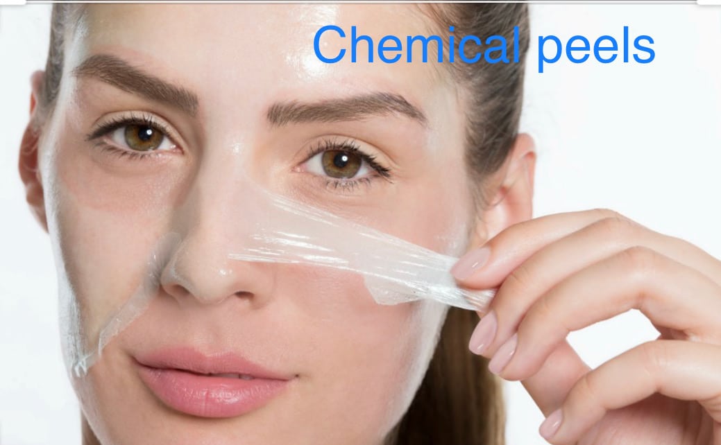 Chemical Peels