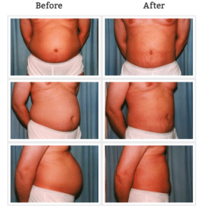before and after liposuction images of a mans torso