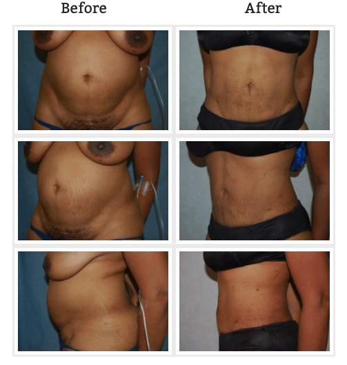 before and after liposuction images of a womans torso