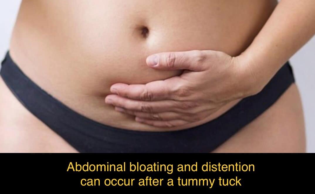 Tummy Tuck Recovery : Less Common Signs and Symptoms Experienced