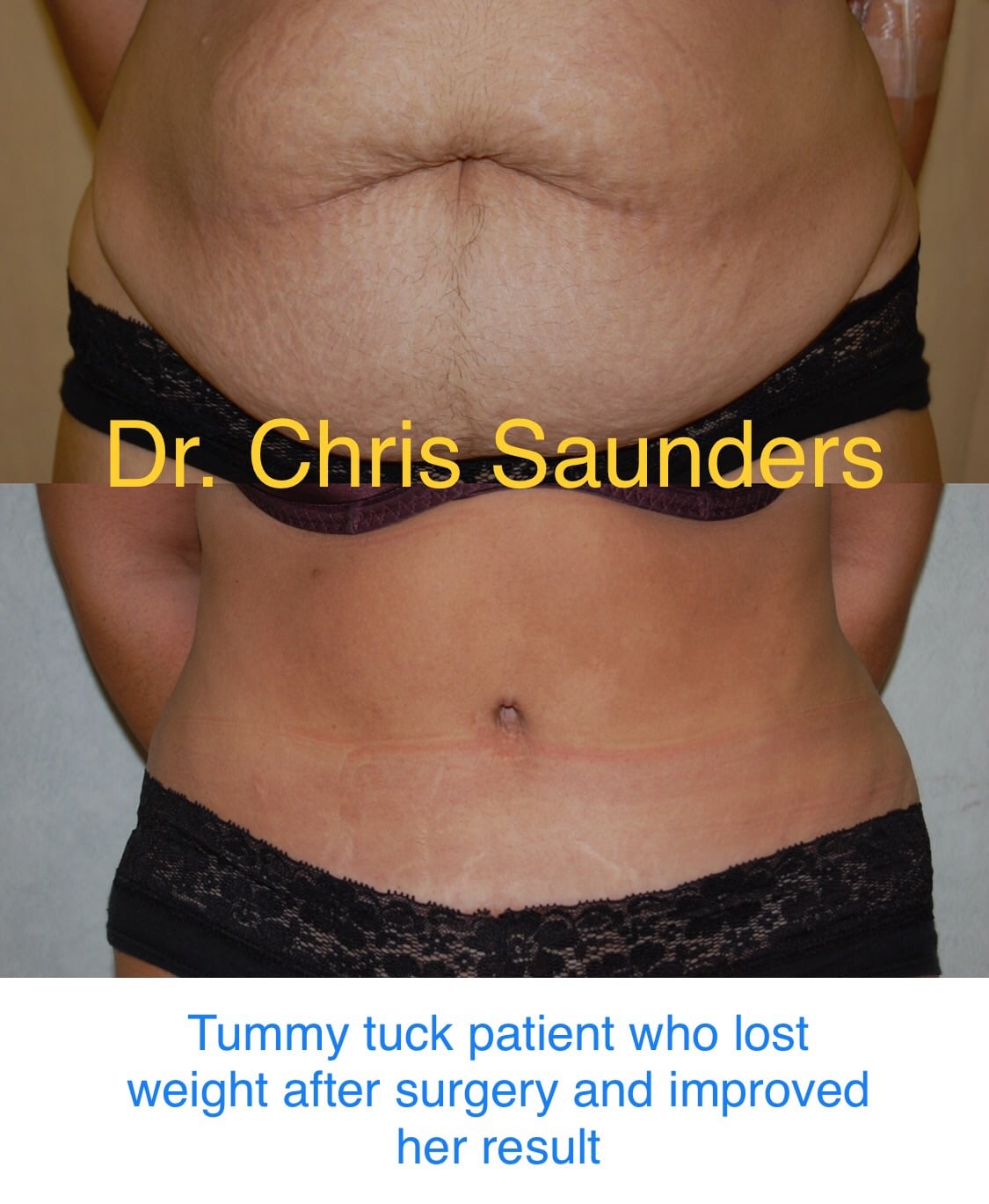 Tummy Tuck and Weight Loss: When is the Best Time to Lose Weight