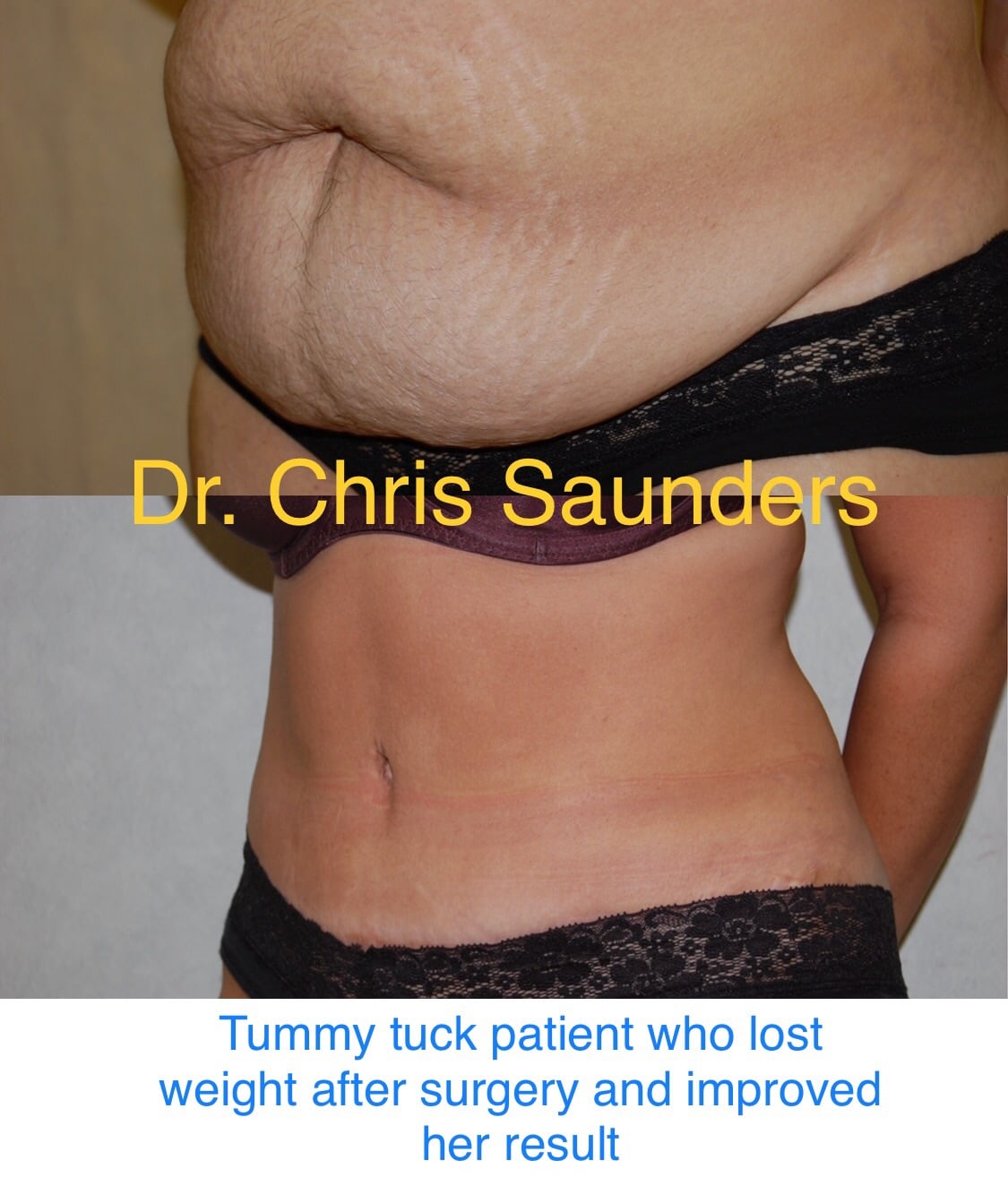 Tummy Tuck and Weight Loss: When is the Best Time to Lose Weight?
