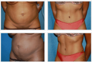 Mini Tummy Tuck Maryland, Baltimore