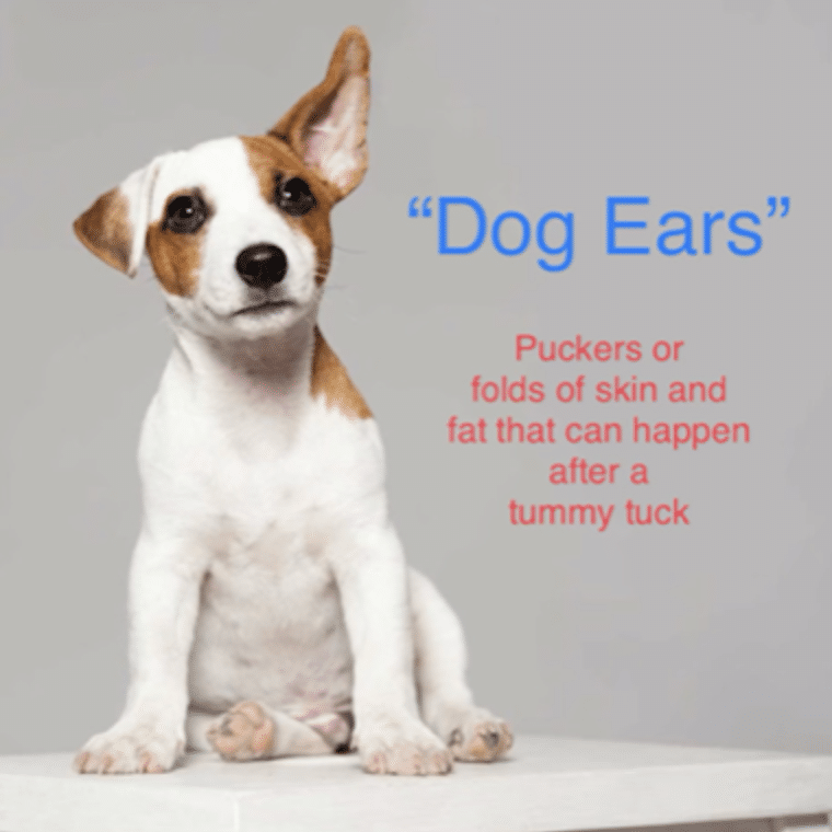 "Dog Ears" and Tummy Tucks What is this all about? Dr. Chris Saunders MD